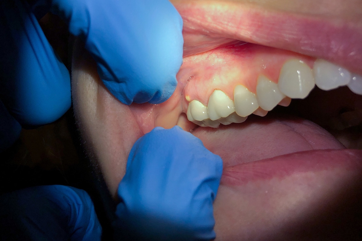 Signs of an abscessed tooth and why you shouldnt ignore it blog